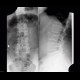 Fracture of lumbar vertebra, comminuted, burst fracture: X-ray - Plain radiograph